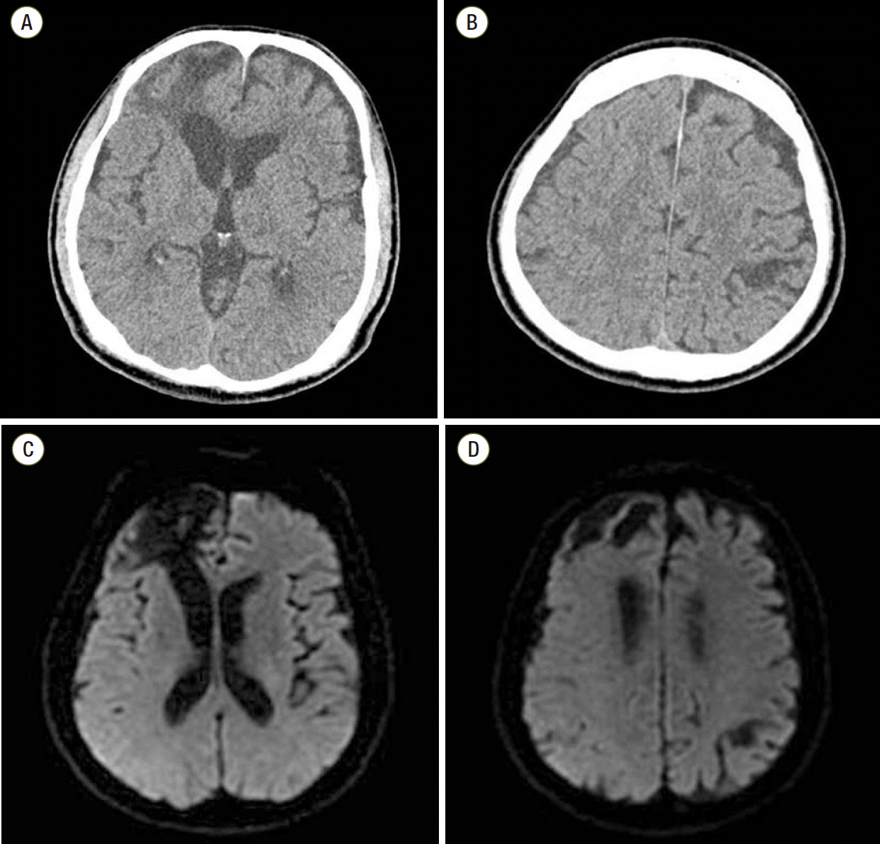 Fatal Intracranial Hemorrhage in a Patient with Disseminated ...